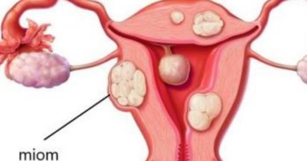 Миома отзывы. Интрамурально субсерозная миома. Миома доброкачественная опухоль. Множественная субсерозная миома матки. Интерстициально-субсерозный узел.