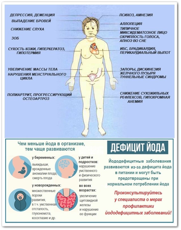 Переизбыток йода симптомы. Дефицит йода симптомы. Заболевания при нехватке йода. Болезнь из за нехватки йода. Недостаток йода в организме.