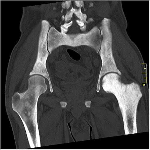 Кт костей скелета. Остеосклероз на кт. Диффузный остеосклероз кт. Пятнистый остеосклероз. Очаговый остеосклероз кт.