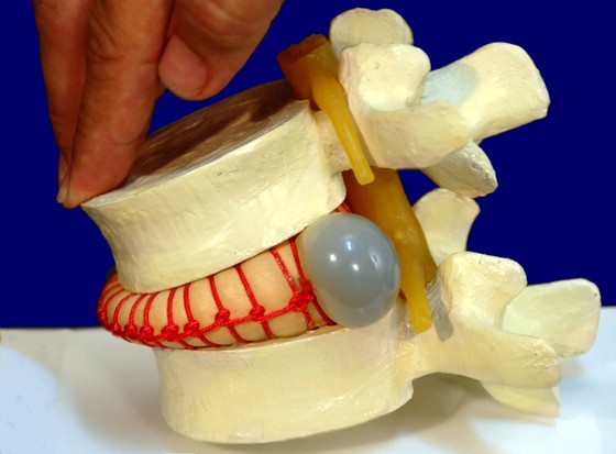 Грыжа позвоночника лечение операции. Операция по имплантации межпозвоночной поясничной грыжи. Межпозвоночный диск фото в живую. Какие импланты есть при операции на межпозвоночную грыжу.