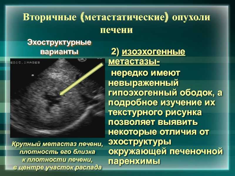 Паренхима пониженной эхогенности. Объемные образования печени на УЗИ. Гиперэхогенная структура печени.