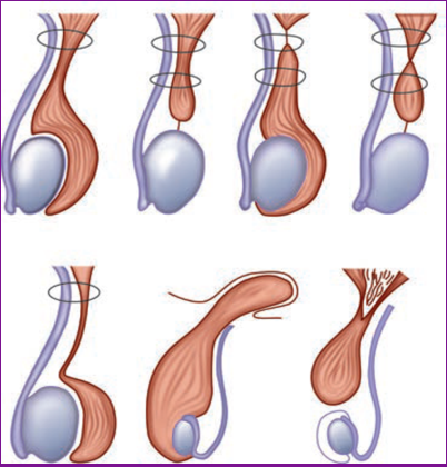 Варикоцеле 2 3