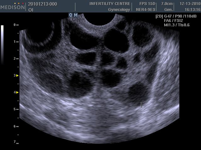 Один яичник форум. Синдром гиперстимуляции яичников УЗИ. УЗИ мультифолликулярных яичников.