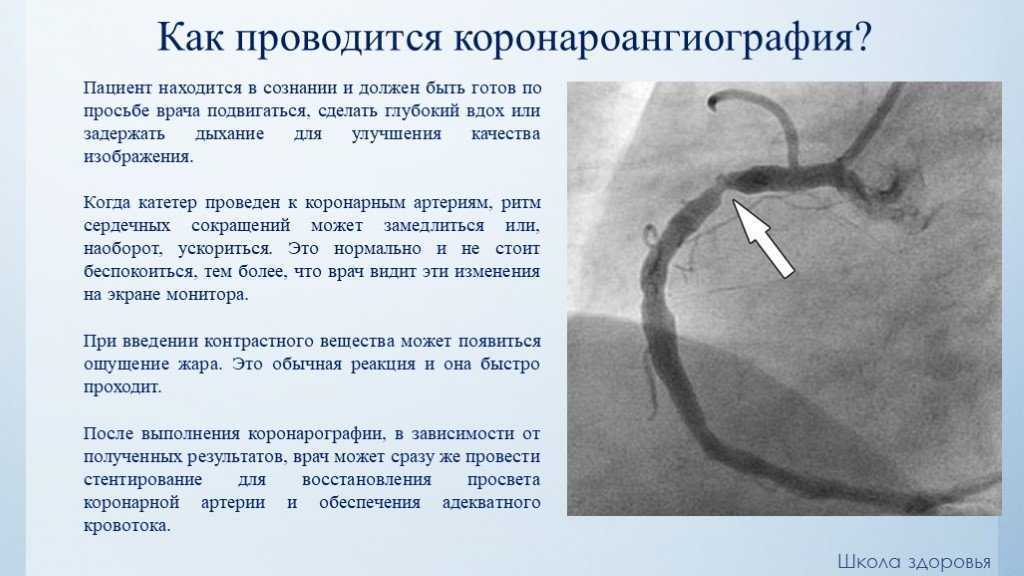 После проводится. Коронарография как делают. Рентгеноконтрастная коронарография. Метод исследование коронарография. Операция коронарография сосудов сердца.