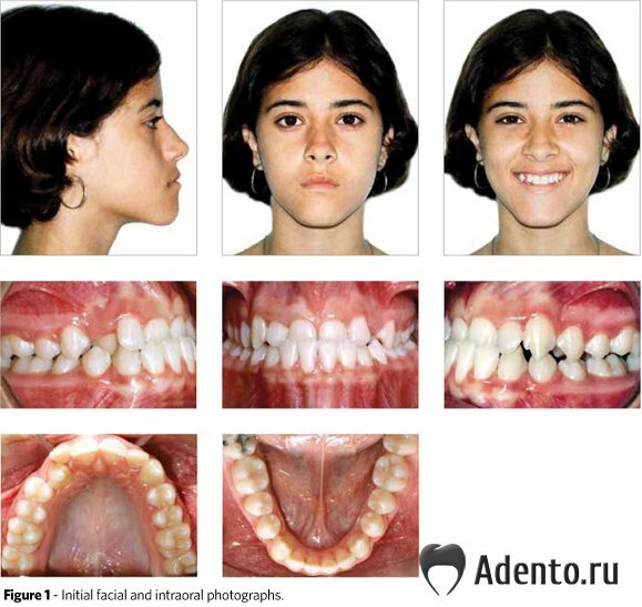 Зубы при закрытом рте. Ортогнатия мезиальный прикус. Дистальный прикус это патология. Правильный прикус у человека челюсть. Правильный и неправильный прикус.