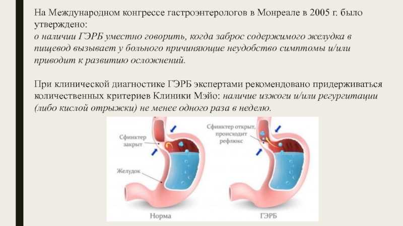 Заброс кислоты из желудка в пищевод