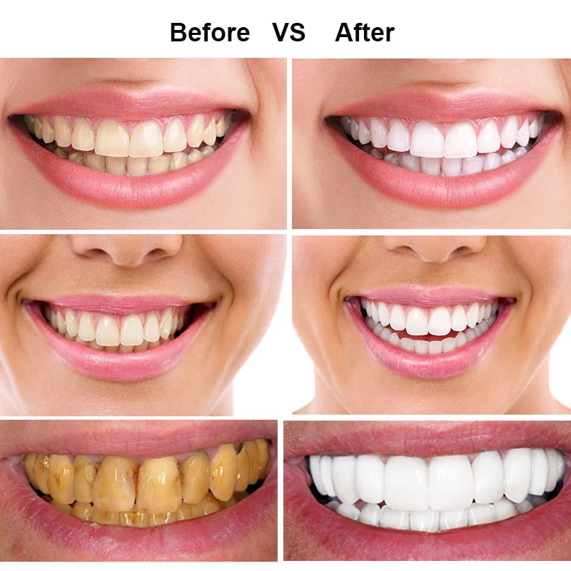 Отбеливание зубов активированным. Отбеливание зубов. Отбеливание зубов до и после. Зубы до и после отбеливания.