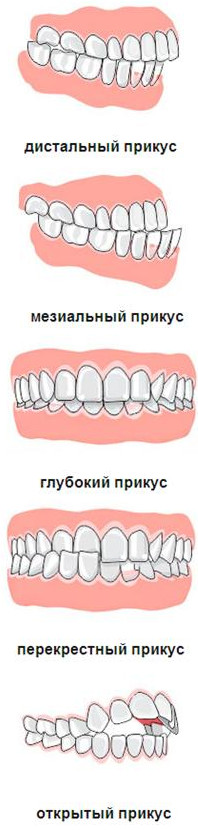 Мезиальный прикус это