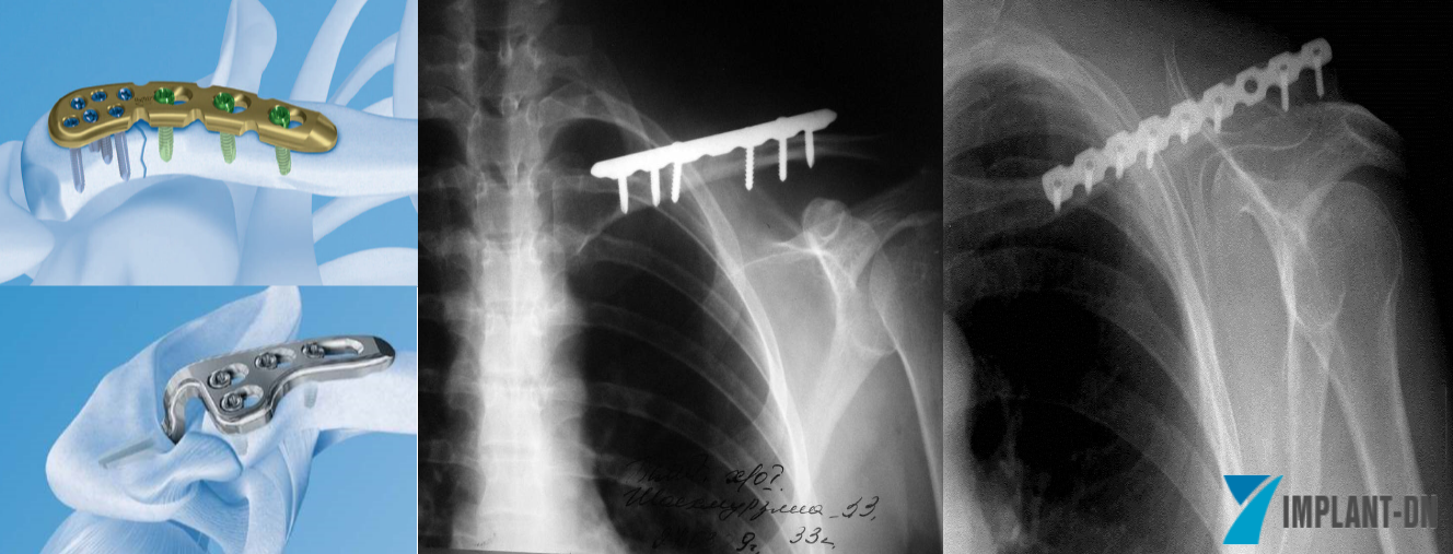 Пластина после. Периимплантный перелом ключицы. Внутрикостный остеосинтез ключицы. Остеосинтез левой ключицы. Вправление перелома ключицы.
