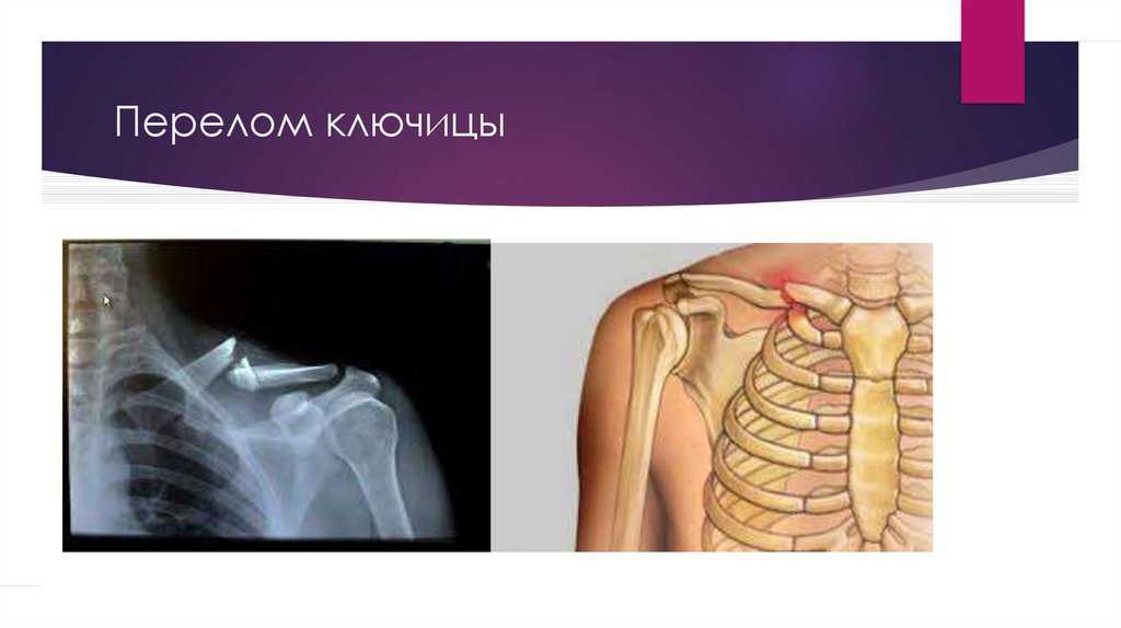 Симптомы перелома ключицы