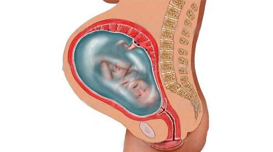 Матка на 21 неделе беременности. Причины многоводия при беременности. Многоводие при беременности многоплодная беременность. Многообразная акушерская патология многоводие.