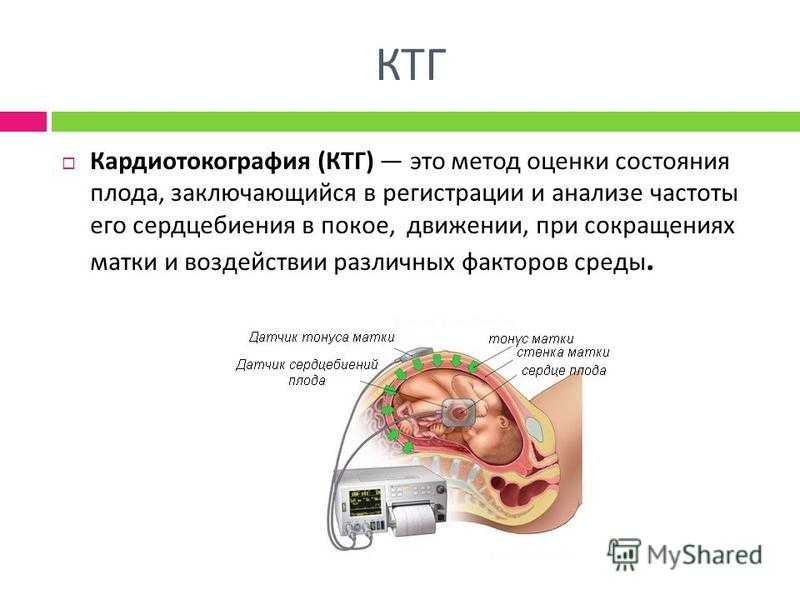 Ктг при беременности что. Оценка состояния плода методом КТГ. КТГ плода методика. КТГ как ставить датчики.