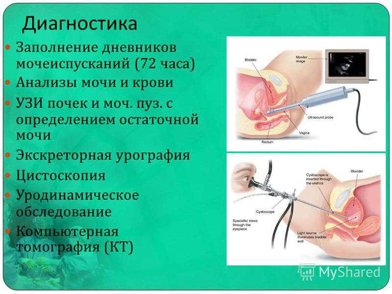 Цистоскопия мочевого у женщин