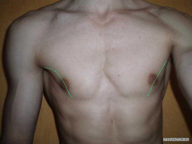 Удаление грудной мышцы. Асимметрия грудных мышц. Асимметричная грудная клетка. Асимметрия грудной клетки у мужчин. Недоразвитие грудной мышцы.