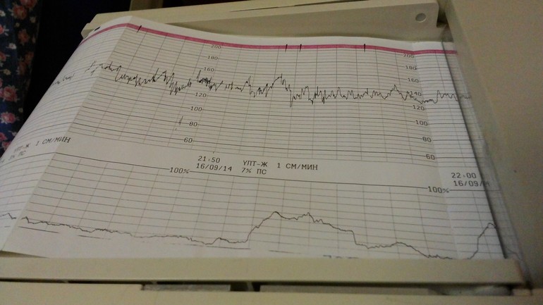 Схватки на ктг. Схватка на КТГ. Первые схватки на КТГ. Тонус на КТГ.