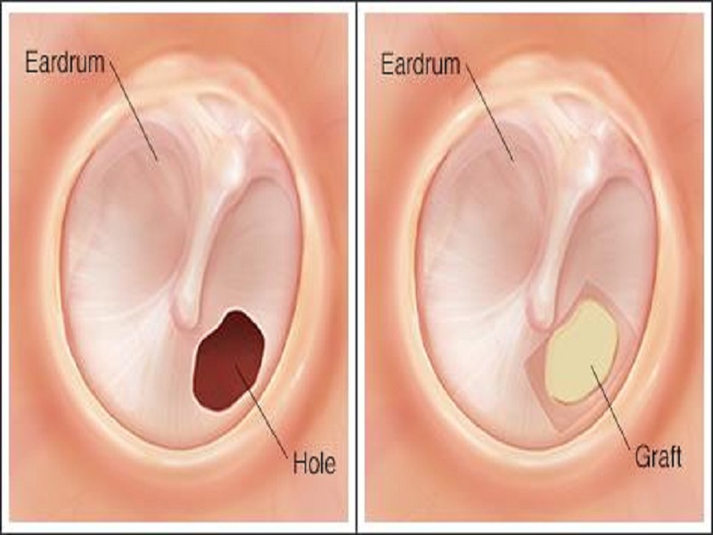 Фото Барабанной Перепонки Уха