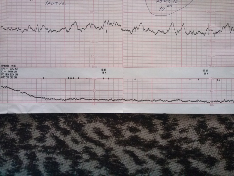 Схватки на ктг. Схватка по КТГ. КТГ тонус матки норма. КТГ на схватках. Тренировочные схватки на КТГ.