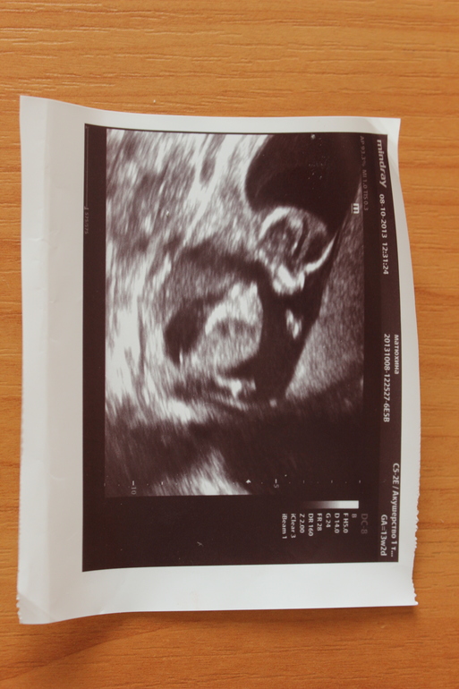 Узи ребенка на 13 неделе. УЗИ 13 недель беременности. Снимок ребенка на УЗИ. УЗИ 13-14 недель беременности.