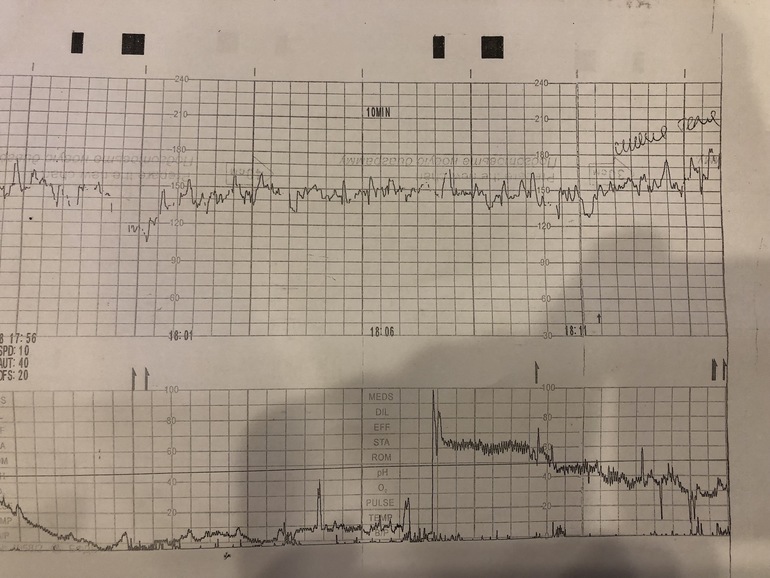 Ктг на 39 неделе беременности