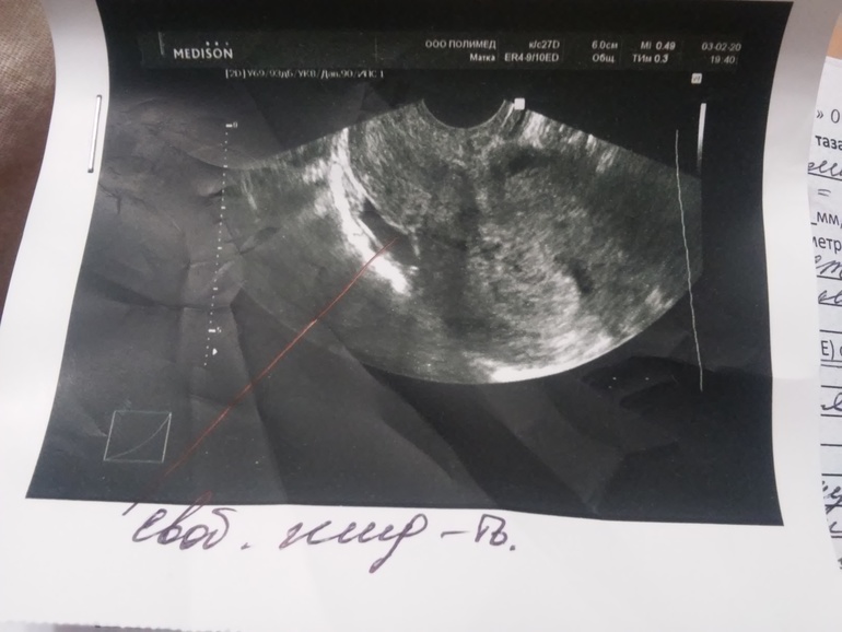На узи видно внематочную. УЗИ внематочной беременности 5 недель.