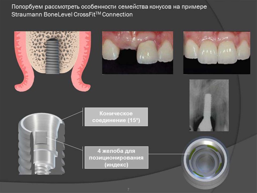 Зубы импланты поэтапно. Этапы имплантации зубов. Поэтапное имплантирование зубов. Поэтапная имплантация зубов. Процесс имплантации зубов пошагово.