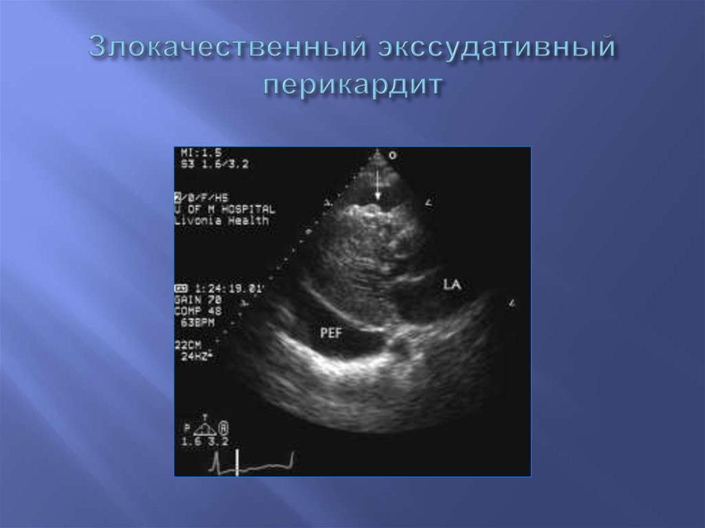 Выпотной перикардит. Экссудативный перикардит эхокардиография. Констриктивный перикардит ЭХОКГ. Выпотной перикардит ЭХОКГ. Острый экссудативный перикардит ЭХОКГ.