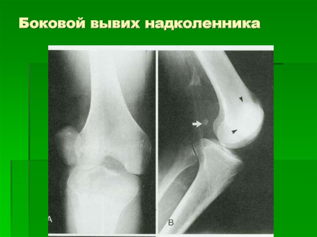 Вывих кости. Рентген картина вывиха надколенника. Вывих надколенника рентгенограммы. Рентген коленного сустава перелом надколенника. Подвывих коленного сустава рентген.