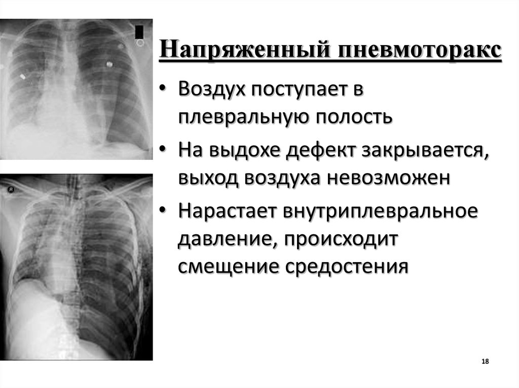 Причины пневмоторакса