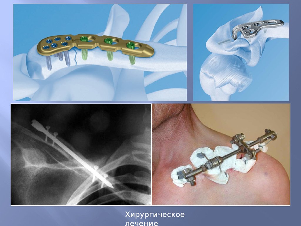 Пластина при переломе. Аппарат внешней фиксации при переломе ключицы. Остеосинтез ключицы пластиной. Пластина при переломе ключицы.