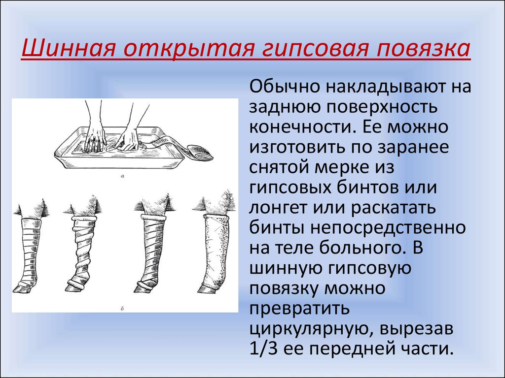 Циркулярная гипсовая повязка