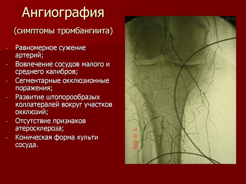 Окклюзионная артерия. Болезнь Бюргера ангиография. Облитерирующий тромбангиит ангиография. Ангиография артерий со стенозом. Ангиография облитерирующего тррмбангита.