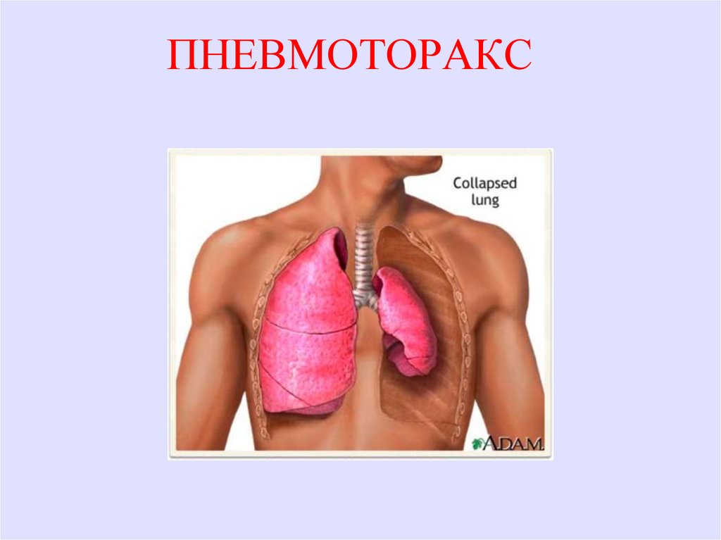 Спонтанный пневмоторакс картинки