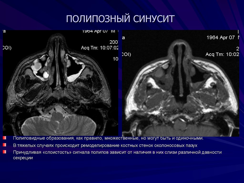 Воспаление синусов. Хронический полипозный риносинусит мрт. Полипозный хронический синусит на кт. Полипозный верхнечелюстной синусит кт. Хронический полипозный гайморит кт.