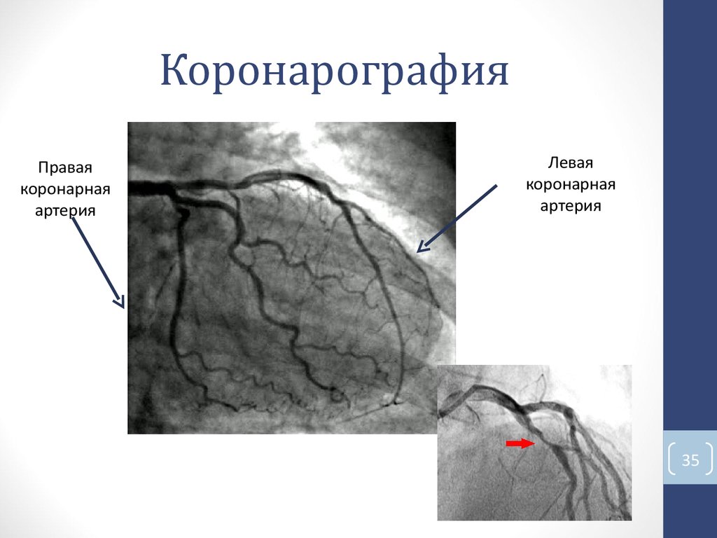 Коронография что такое. Коронарные артерии на коронарографии. Коронарография сосудов сердца норма. Правая коронарная артерия ангиограмма. Коронарные сосуды сердца коронарография.