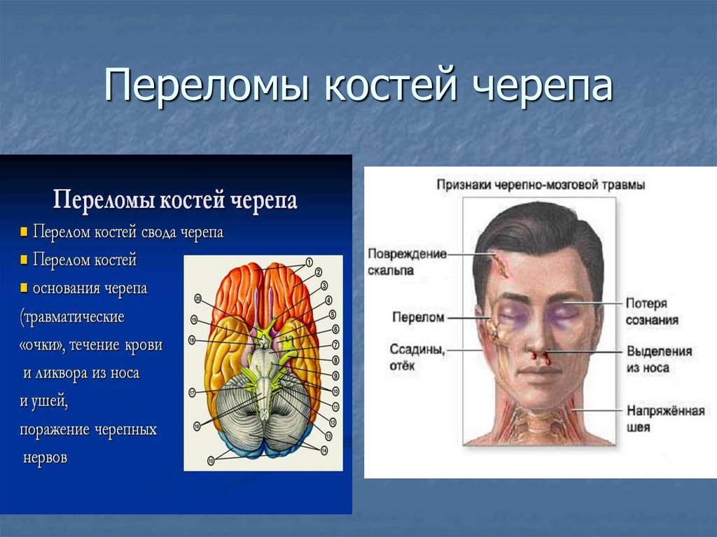 Перелом основания черепа карта вызова