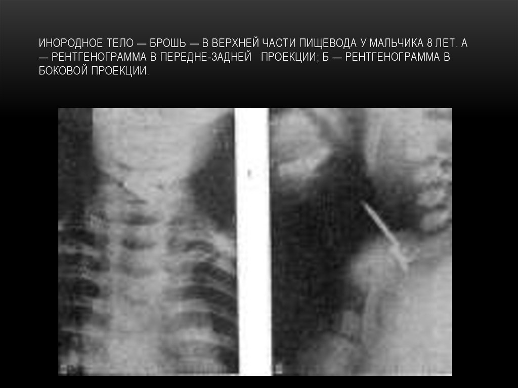 Инородное тело. Рентгенодиагностика инородных тел пищевода. Инородное тело пищевода у ребенка дифдиагностика. Инородные тела пищевода рентгенограммы. Инородное тело пищевода рентгеноскопия.