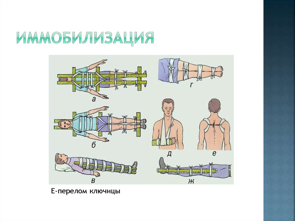 Как спать при переломе ключицы в гипсе картинки