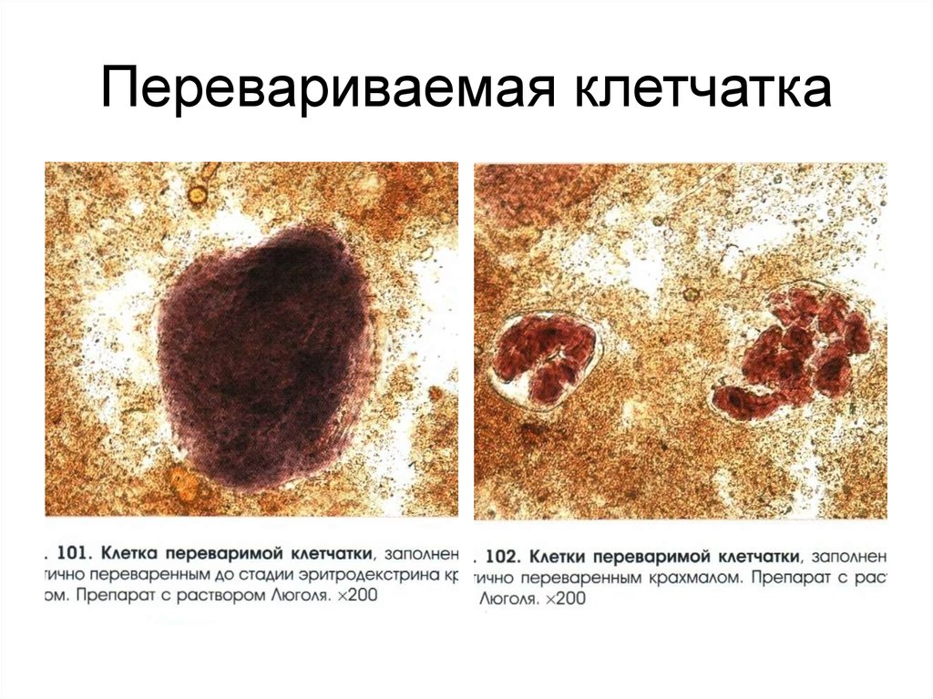 В копрограмме непереваренные