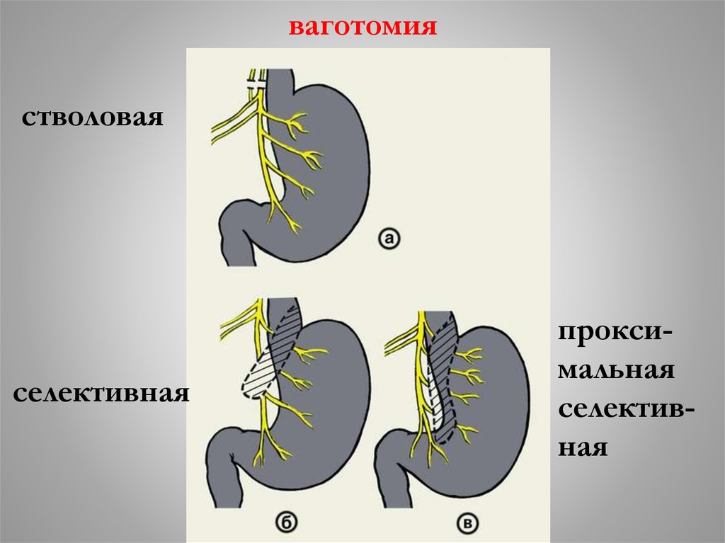 Пилоропластика по финнею схема