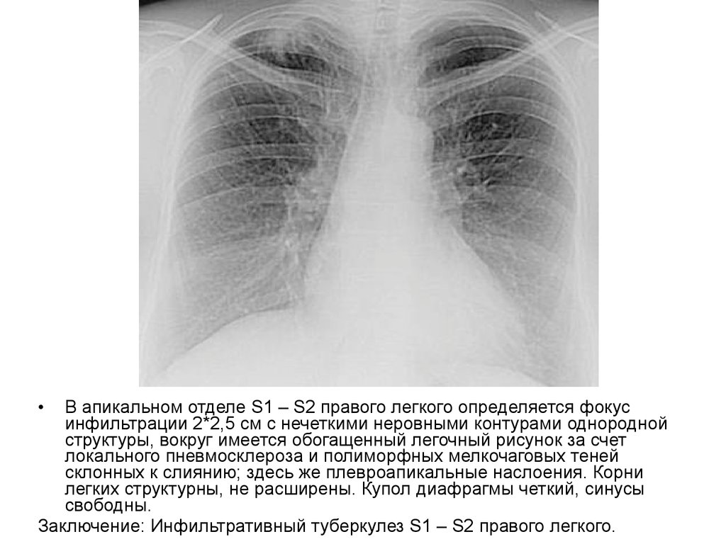 Отделы легочного рисунка. Инфильтративный туберкулез s1-2 правого легкого. Рентген апикальные плевральные наложения. Апикальные плевральные наслоения рентген. Легочный рисунок обогащен.