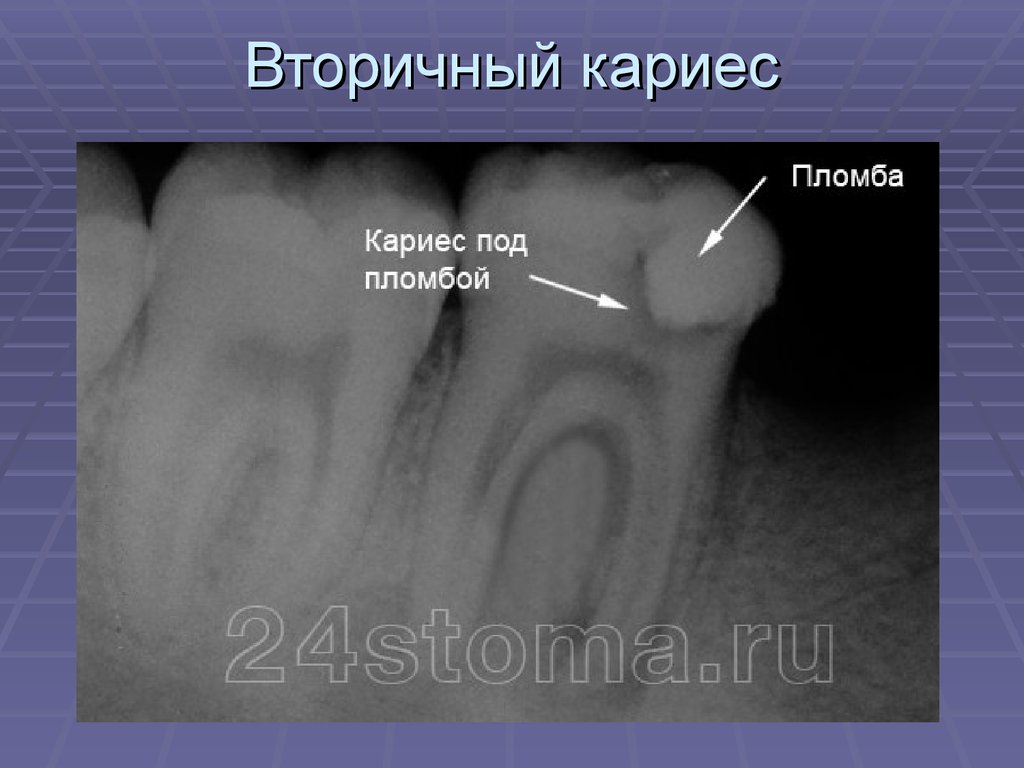 Кариес Жевательных Зубов Фото