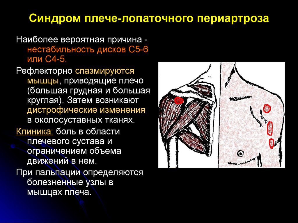 Периартрит плечевого сустава симптомы и лечение