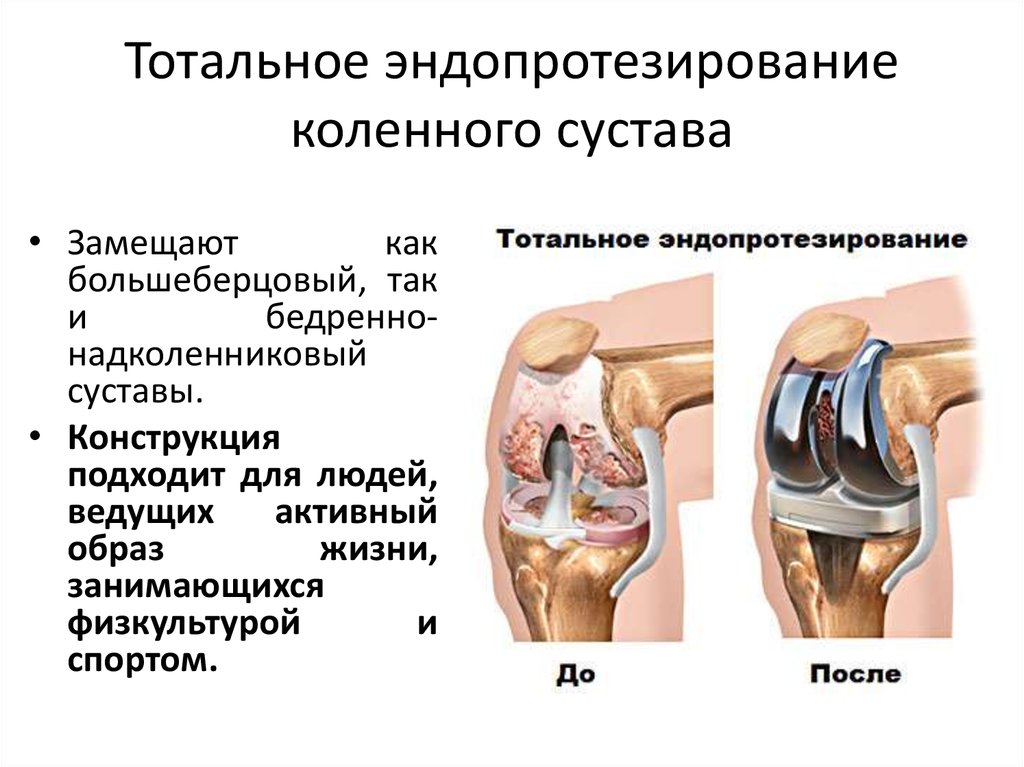 Почему колено после эндопротезирования. Эндопротезирование коленного и тазобедренного сустава. Компоненты эндопротеза коленного сустава. Модульный эндопротез коленного сустава. Артроз коленного сустава эндопротез.