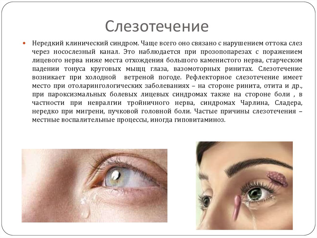 Что делать после слез. Причины слезотечения глаза. Причина слезятся глаза у человека. Слезоточивость глаз причины.