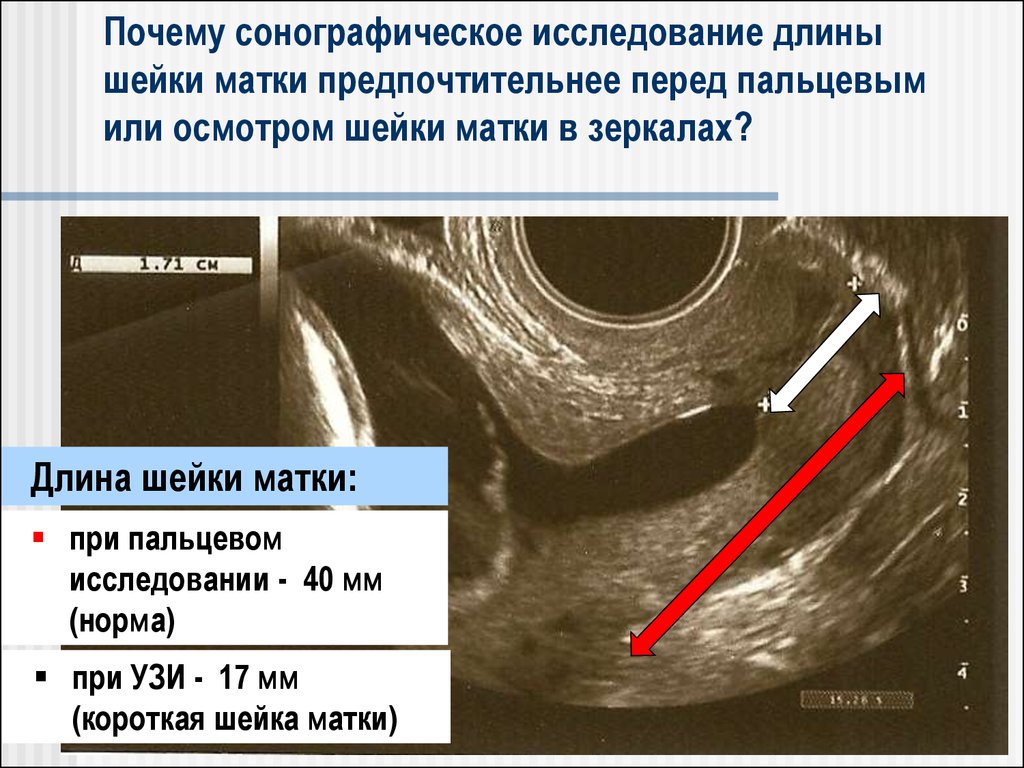 Матка 25 мм. Нормальная матка на УЗИ. Шейка по срокам беременности. Наружный и внутренний зев матки.
