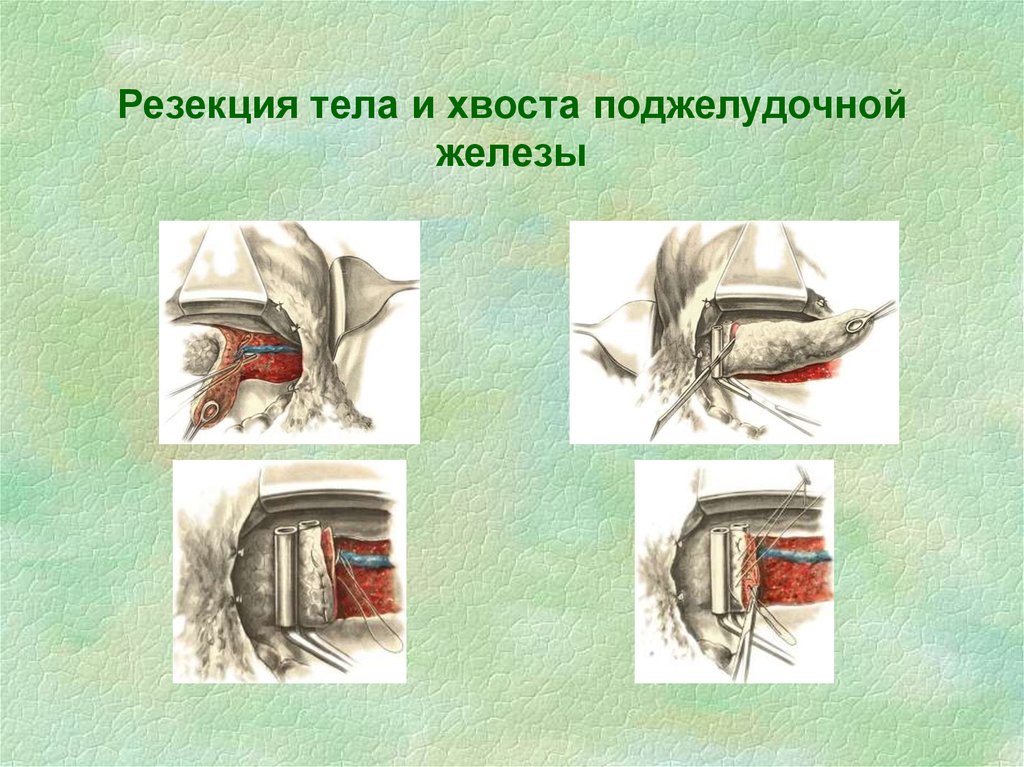 Резекция печени. Корпорокаудальная резекция поджелудочной железы. Корпорокаудальная резекция хвоста поджелудочной железы. Дистальная (левосторонняя) резекция поджелудочной железы. Дистальная субтотальная резекция поджелудочной железы.