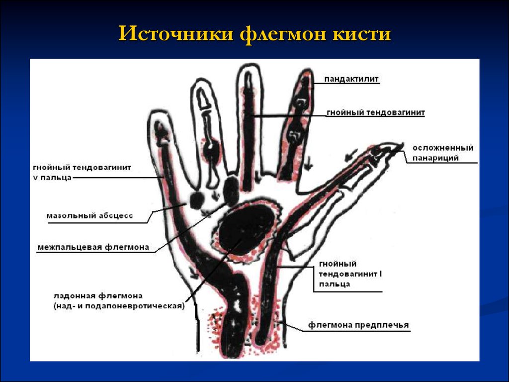 Вскрытие подапоневротической флегмоны