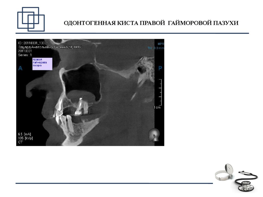 Киста правой верхнечелюстной пазухи фото