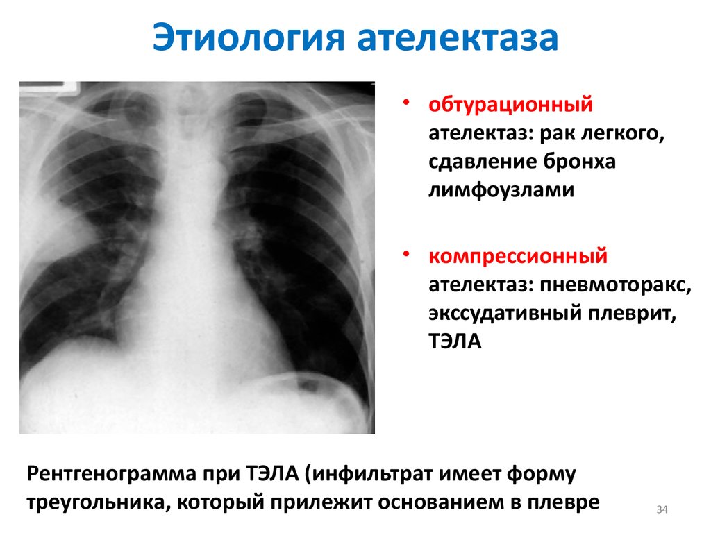 Ателектаз легкого. Компрессионный ателектаз легкого рентген. Тотальный ателектаз левого легкого. Ателектаз верхней доли рентген. Компрессионный ателектаз рентген.