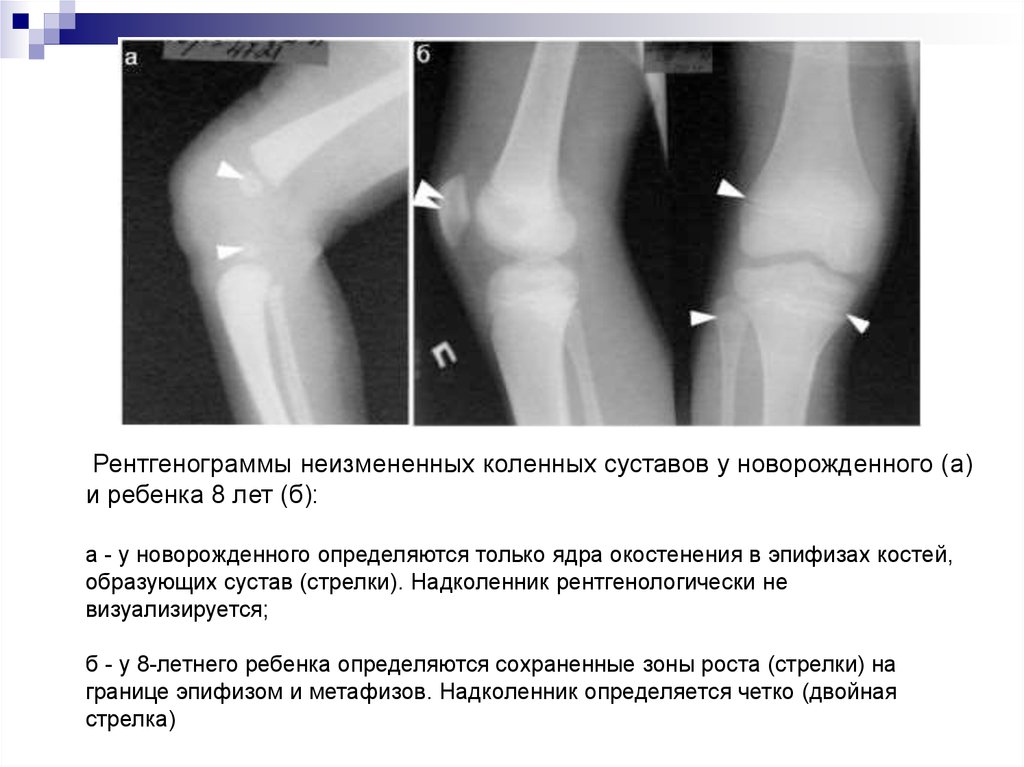 Изображение коленного сустава рентгеновское